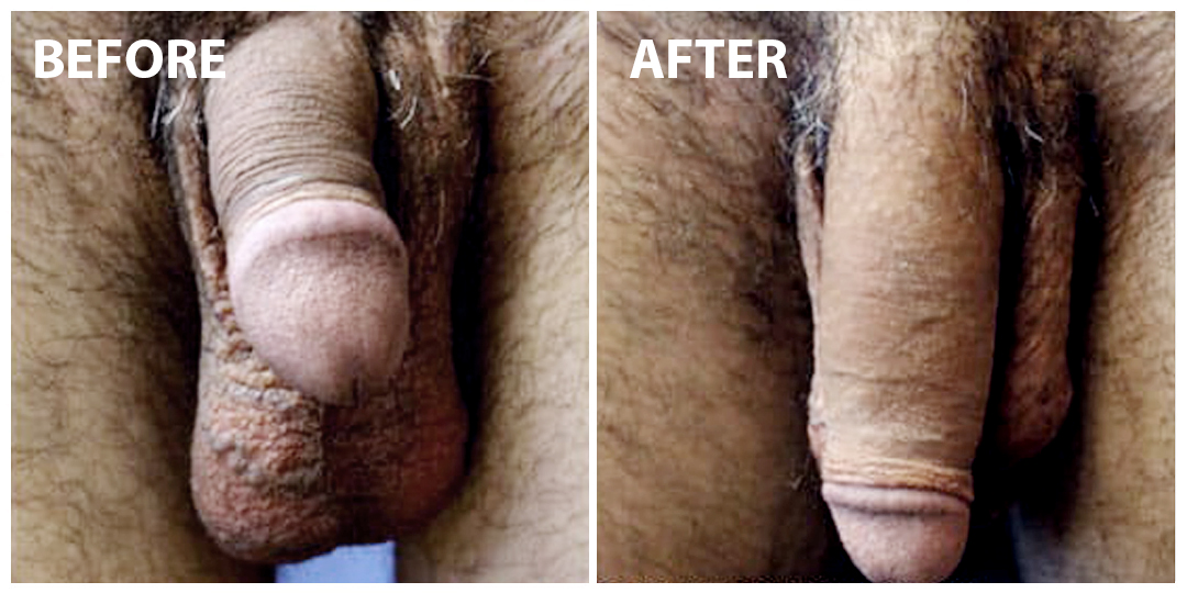 Before & after penis enlargement.