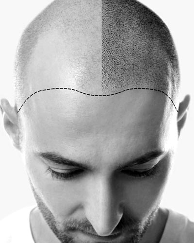 Premier4Him Services FUE HAIR TRANSPLANT