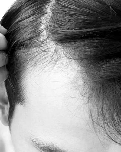 HAIR GROWTH LASER