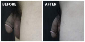 Penis Enlargement Before After