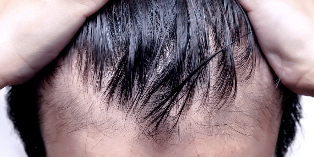 FUE HAIR TRANSPLANT