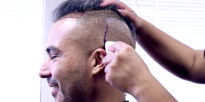 FUE HAIR TRANSPLANT 