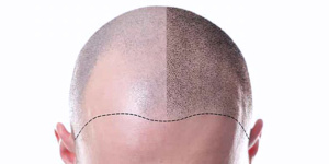 FUE HAIR TRANSPLANT 