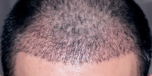 FUE HAIR TRANSPLANT