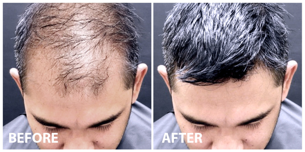 FUE Hair Transplant Before After