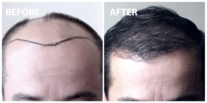 FUE Hair Transplant Before After
