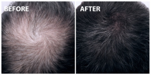 FUE Hair Transplant Before After