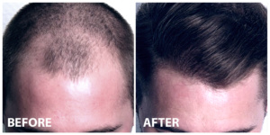 FUE Hair Transplant Before After