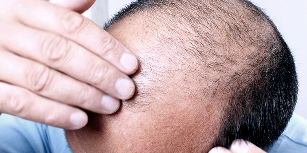 Hair Mesotherapy