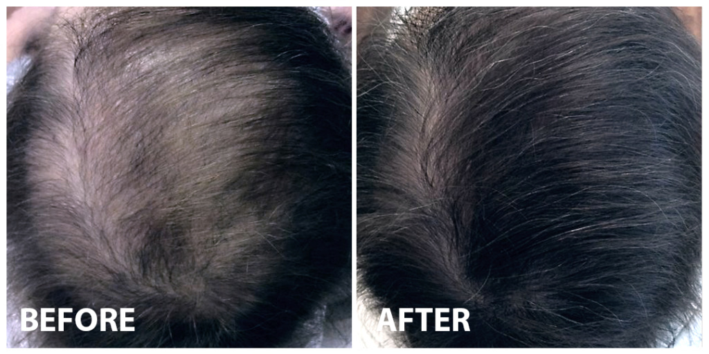 Hair PRP Before After