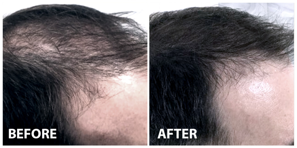 Hair PRP Before After