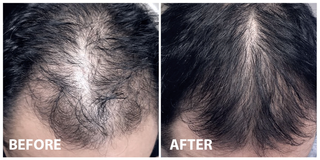 Hair PRP Before After