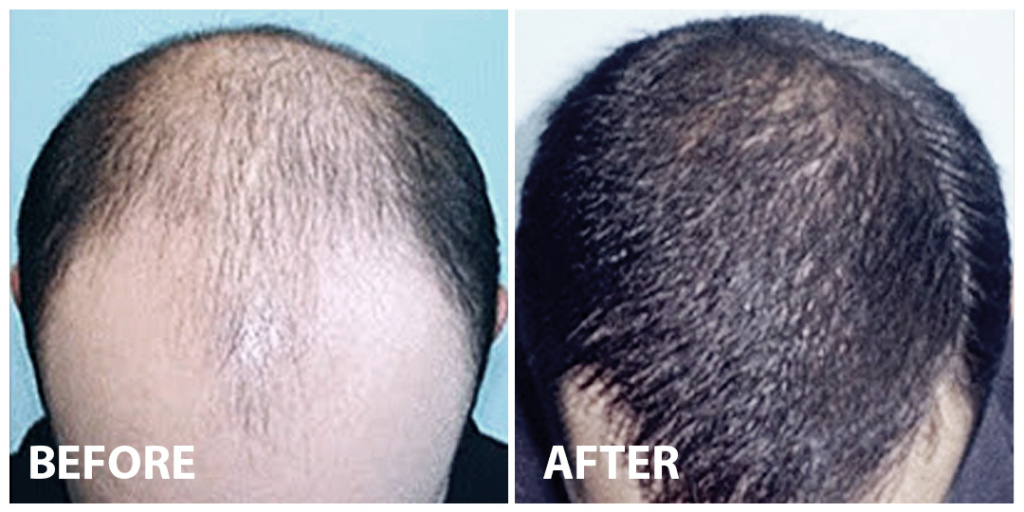 Hair Stem Cells Before After