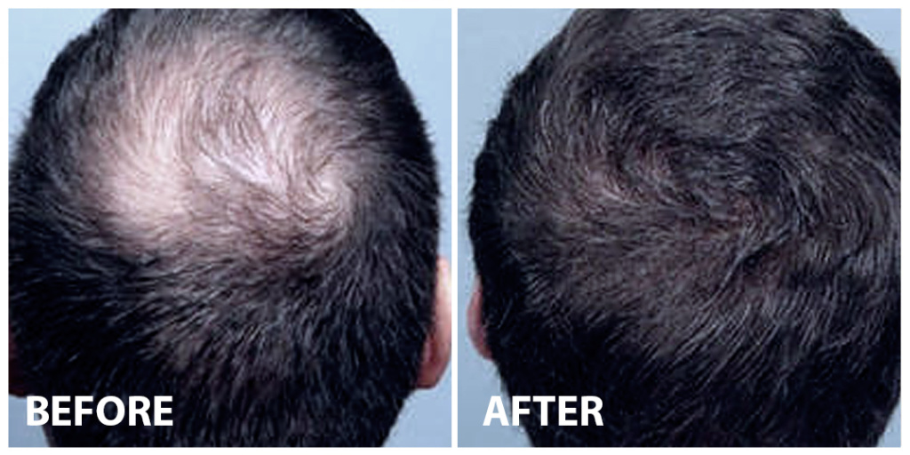 Hair Stem Cells Before After
