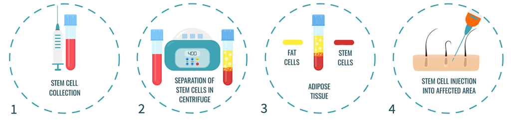 How does Stem Cell Hair Transplant work?