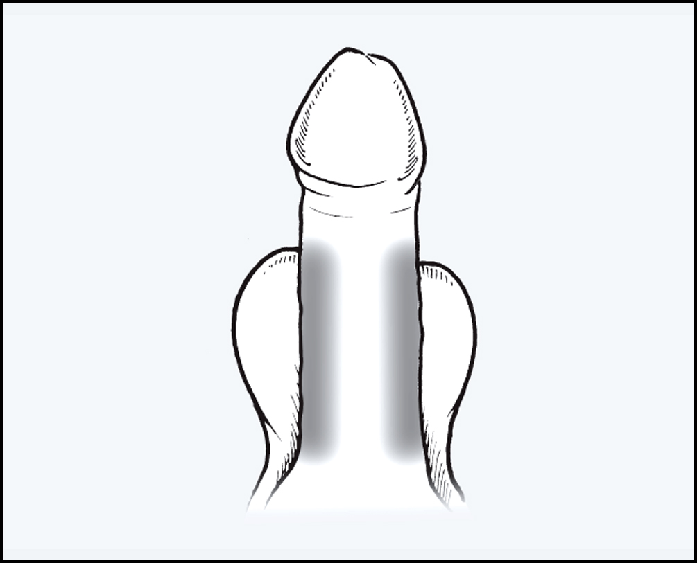Step 6: Target only the side of penis shaft area to be injected. Avoid the top and bottom part. HOW DOES CAVERJECT WORK 06