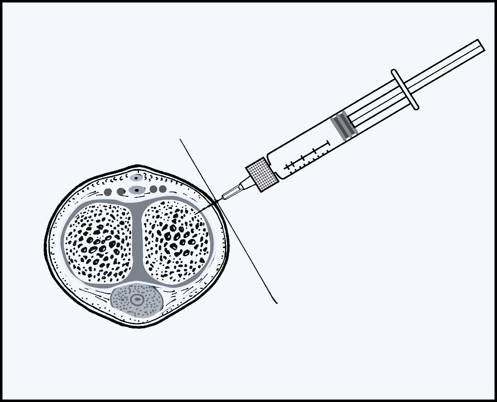 Saline Penis Injection