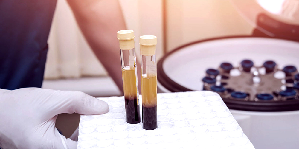 Penis PRP