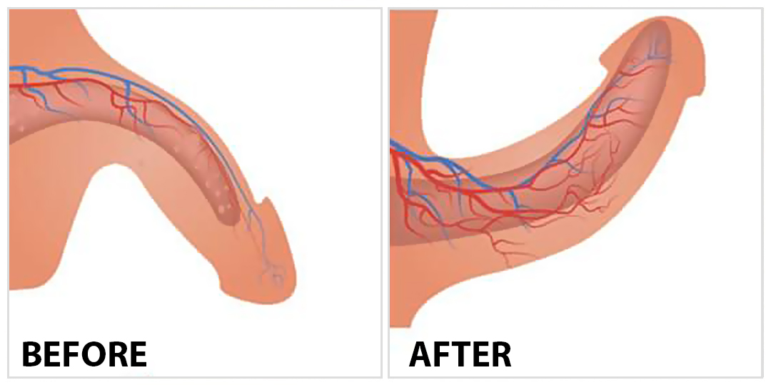 Penis PRP Toxin Before After