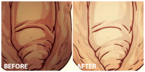 Penis whitening Before After