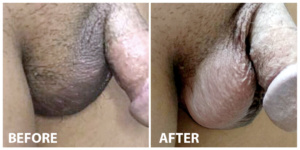 Scrotum Botulinum Toxin Before After