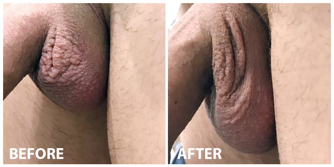 Scrotum Botulinum Toxin Before After