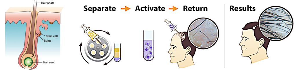 How does Stem Cell Hair Transplant work?