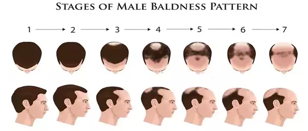 Hair Loss In Asia Hair Loss In Asia