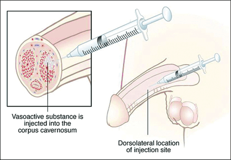 Penis PRP