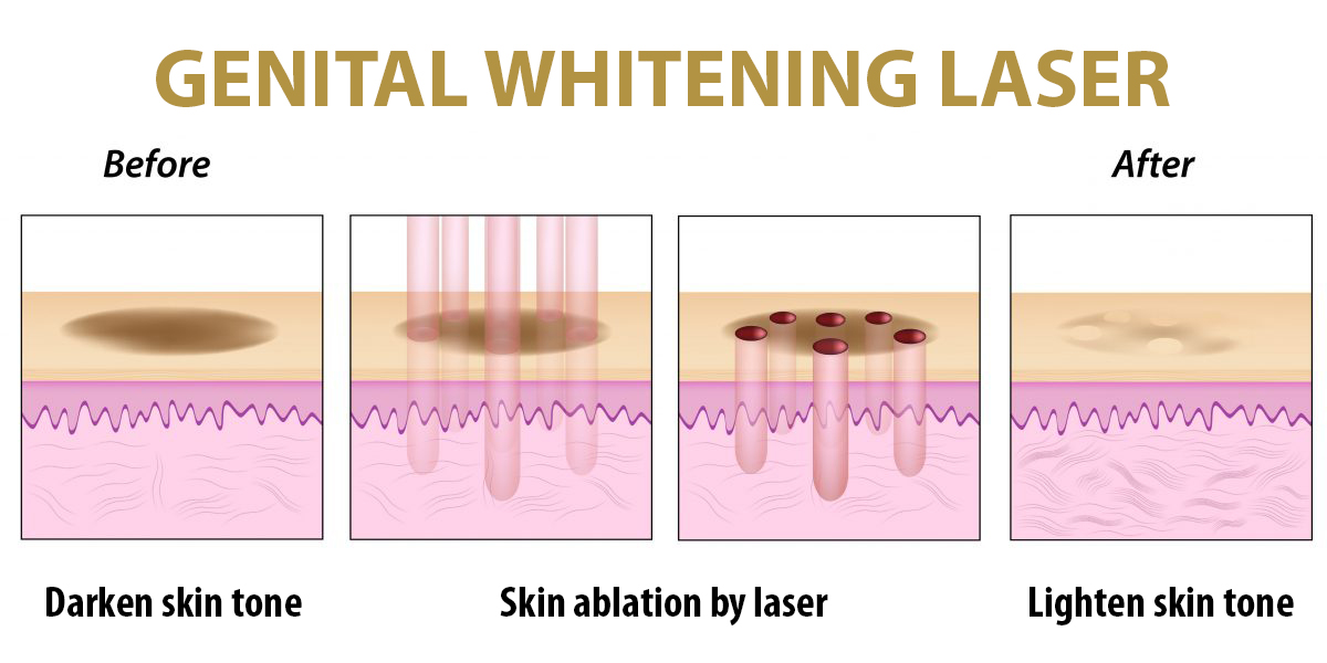 skin whitening laser