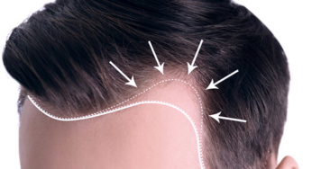 Top Myths & Misconceptions About FUE Hair Transplant Treatments Around KL & Malaysia