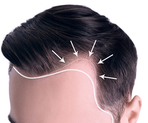 FUE Hair Transplant - Permanent Solution