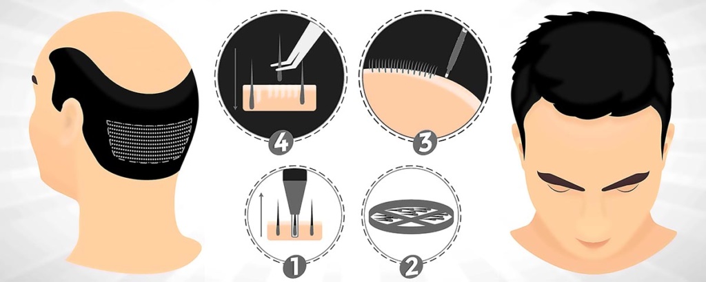 BAGAIMANA RAWATAN TANAM RAMBUT DILAKUKAN?