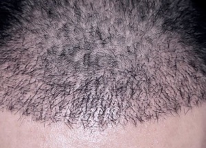 PENANAMAN RAMBUT 