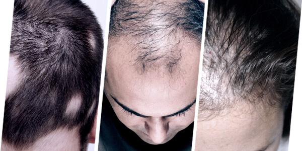 FUE Hair Transplant