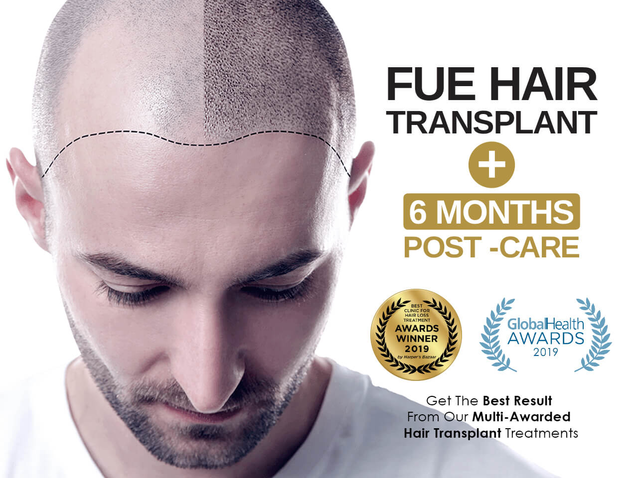 FUE Hair Transplant