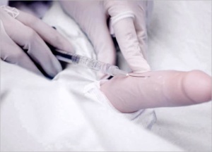 Penis Filler (Filler Zakar) 