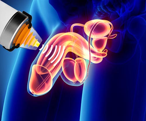 Premier Shockwave therapy
