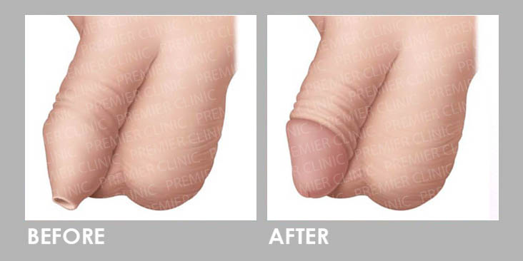 Penis before and after circumcision - Mayo Clinic