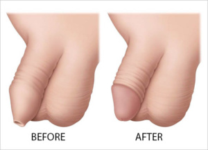 benefits of ZSR Circumcision