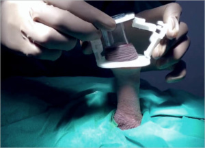 CIRCUMCISION WITHOUT KNIFE