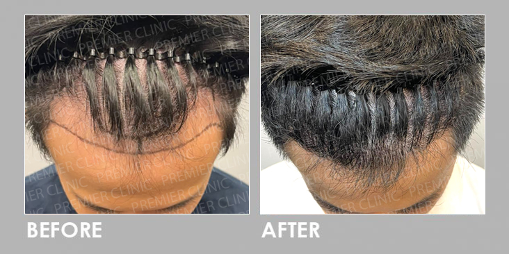 FUE Hair Transplant Before After