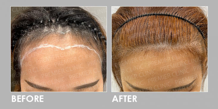 FUE Hair Transplant Before After