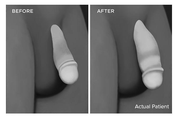 penis filler last how long