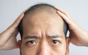Goodbye to balding