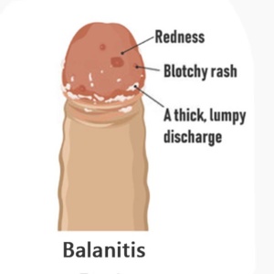Urinary tract infections