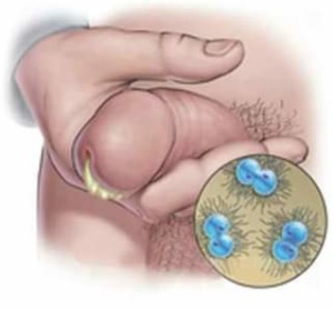 Urinary tract infections