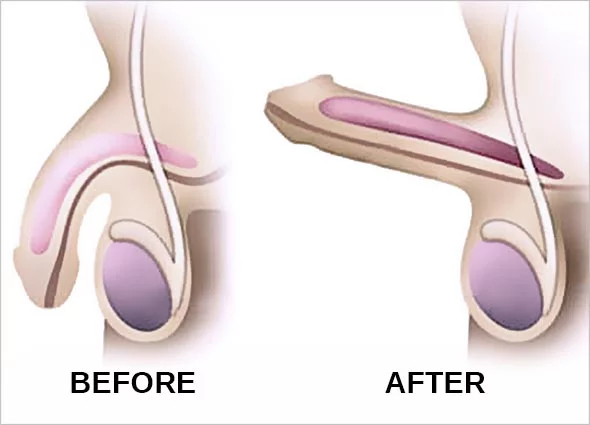 continue erection after cum