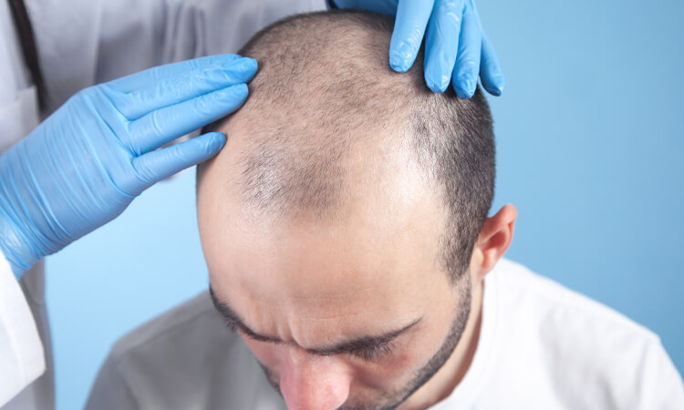 Scalp Micropigmentation