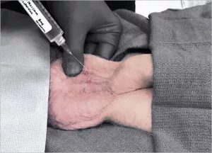 Botox For The Scrotum